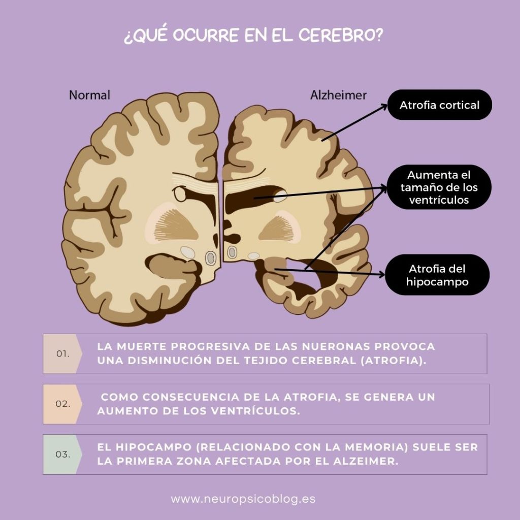 Enfermedad de Alzheimer en personas mayores