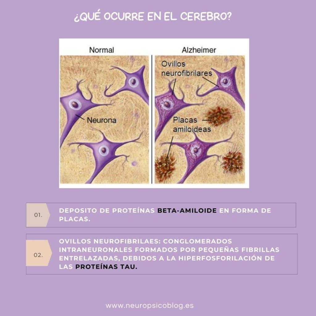 placas amiloideas y ovillos neurofibrilares