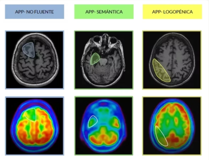 neuroimagen en afasias progresivas